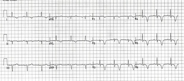 Wellens-deeply-inverted-620x275